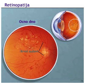 Retinopatija