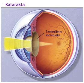 Katarakta